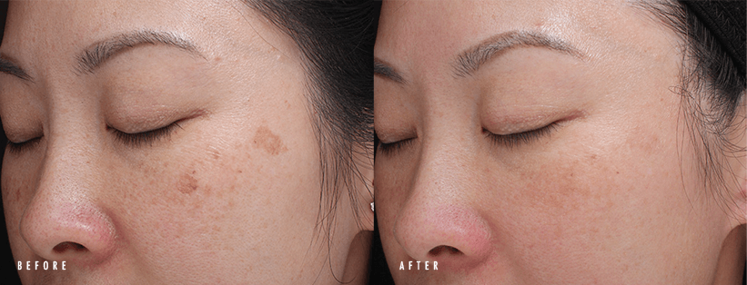 Moxi Laser before and after sun damage