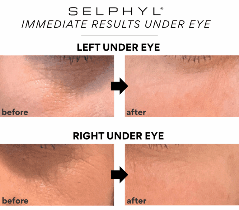Selphyl Immediate results UNDER EYE